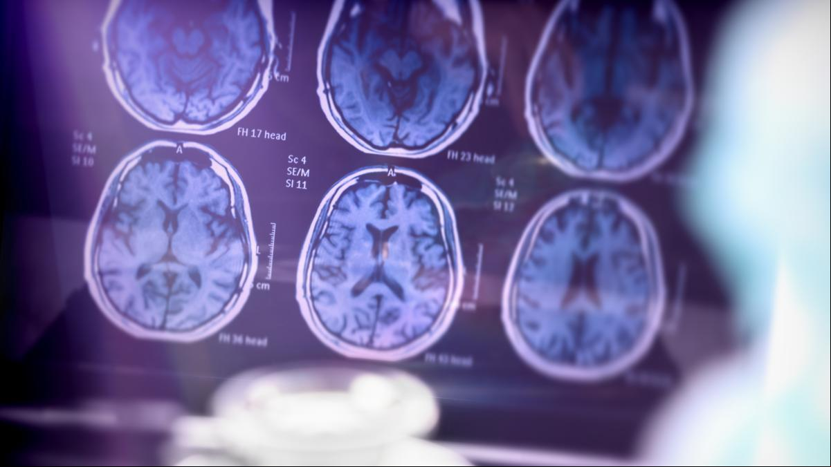 Ictus en jóvenes: cada vez se detectan más